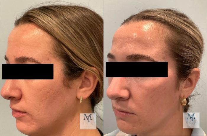 Before & After UltraClear® Laser Skin Rejuvenation Case 55 Left Oblique View in Washington, DC