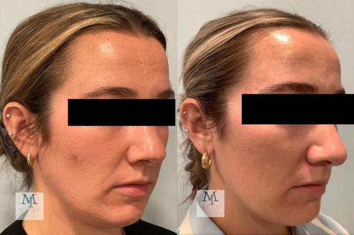 Before & After UltraClear® Laser Skin Rejuvenation Case 55 Right Oblique View in Washington, DC