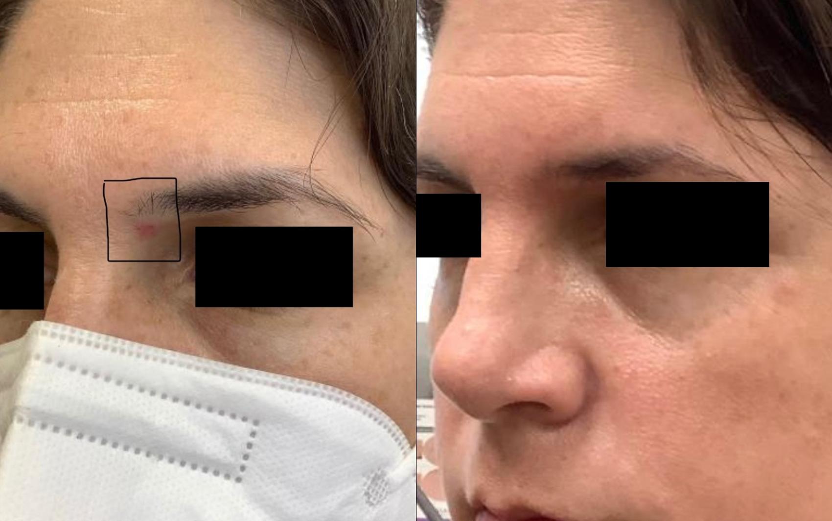 Vbeam Perfecta Case 39 Before & After Right Oblique | Washington, DC | MI Skin Dermatology Center: Melda Isaac, MD