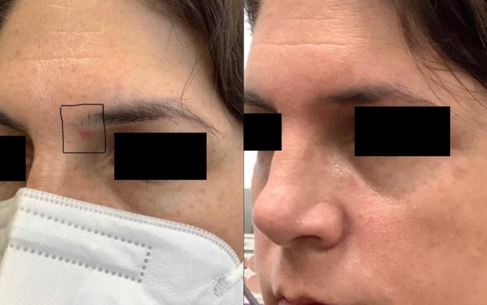 Before & After Vbeam Perfecta Case 39 Right Oblique View in Washington, DC